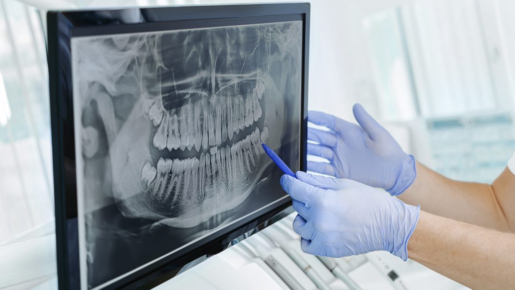 Radiografía para el tratamiento de ortodoncia en adultos