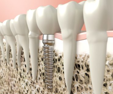 Imagen de implante dental